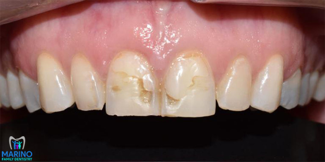 Teeth Restoration Dentist Greater Jacksonville Florida