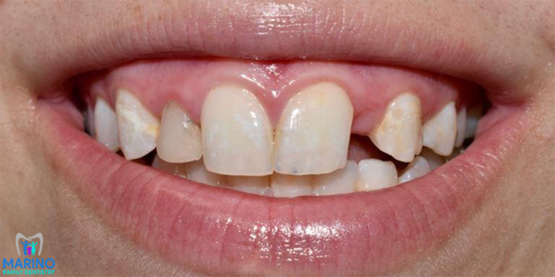 Invisalign Dentists Greater Jacksonville Florida