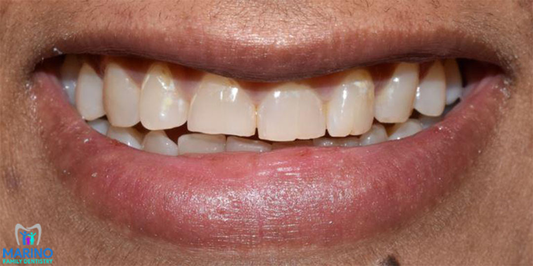 Clear Aligner Dentists Greater Jacksonville Florida