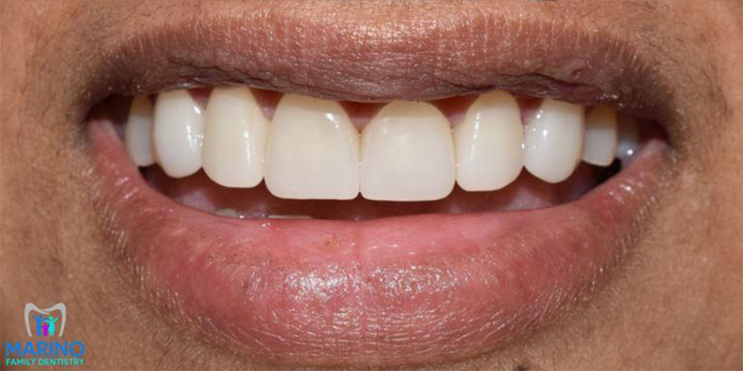 Cerec Same Day Crowns Greater Jacksonville Florida