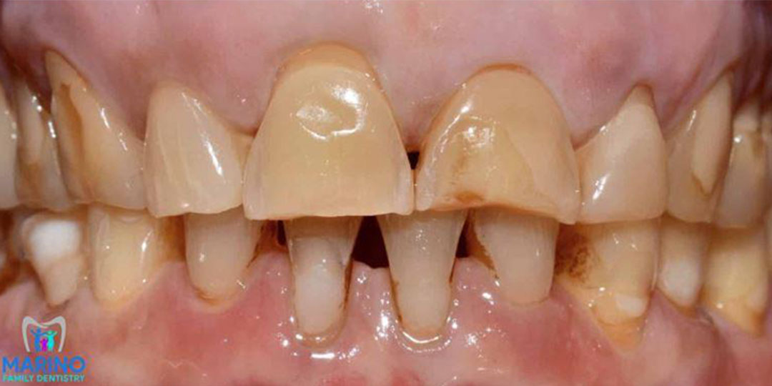 Orange Park Florida Porcelain Veneer Dentist