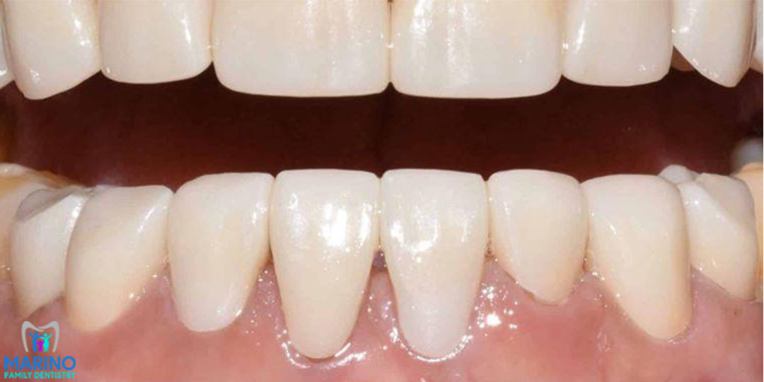 Teeth Whitening Dentist Near Me