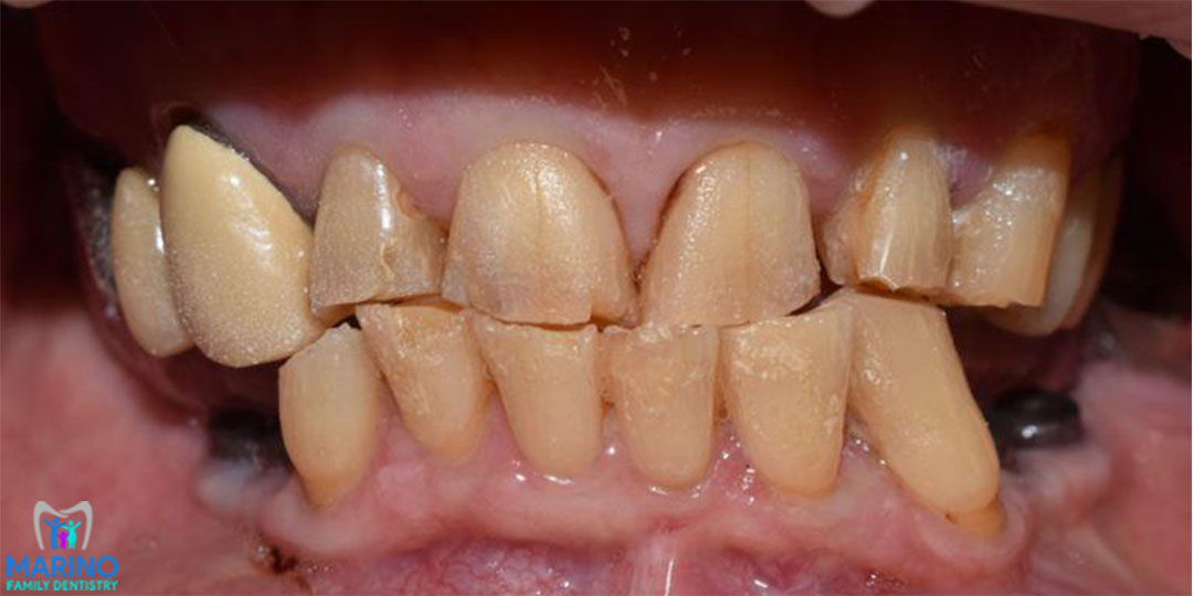 Cosmetic Bonding Dentist Greater Jacksonville Florida