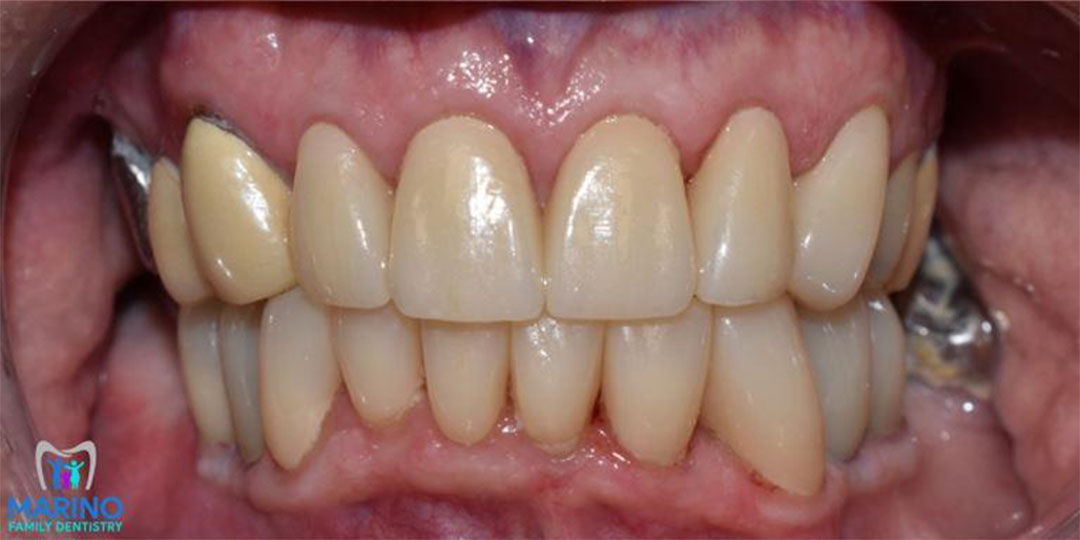 Greater Jacksonville Florida Porcelain Crown Dentist