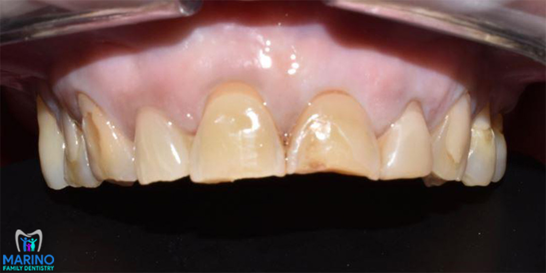 Dental Implant Dentist Greater Jacksonville Florida