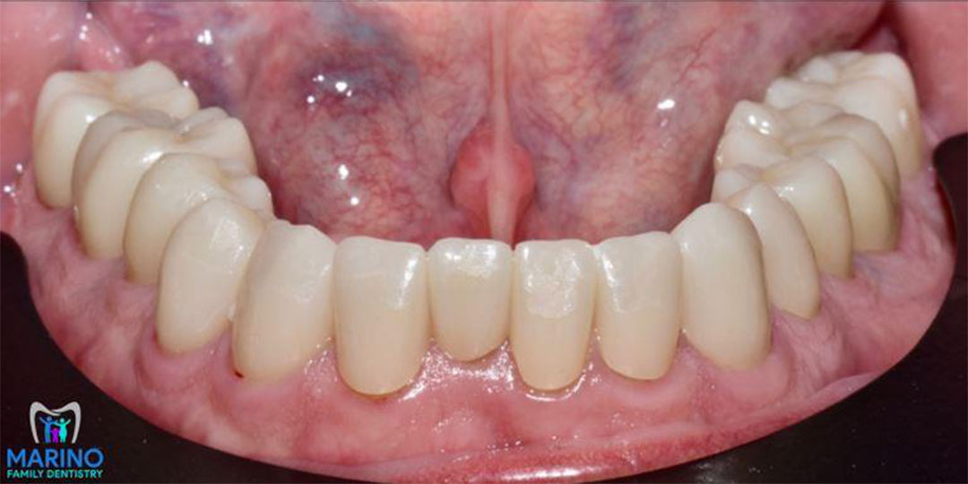 Dental Bridge Dentist Near Me