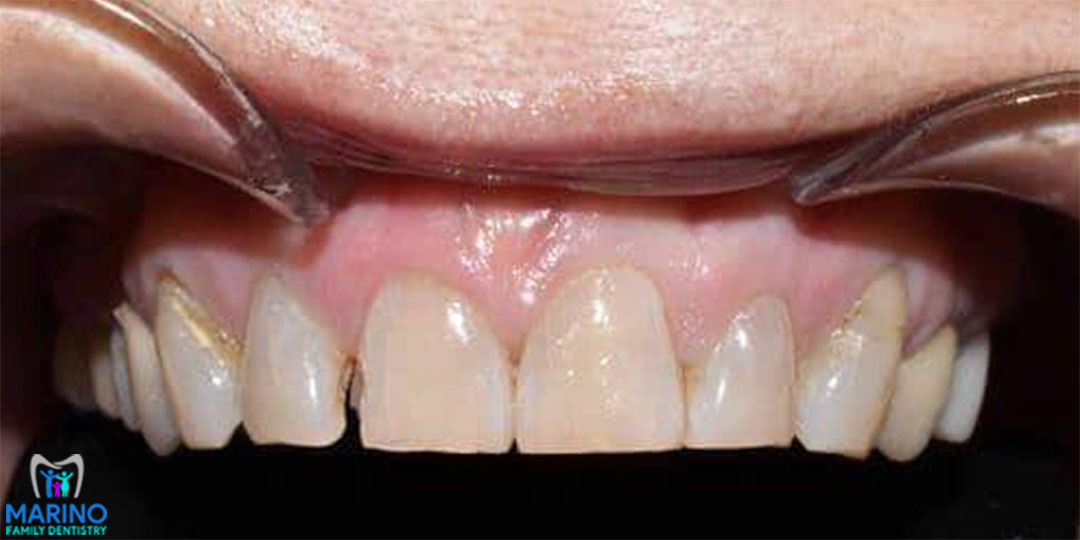 Bone Grafting Dentist Greater Jacksonville Florida