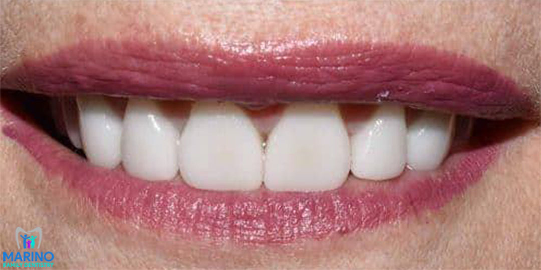 Dental Implant Dentists Near Me