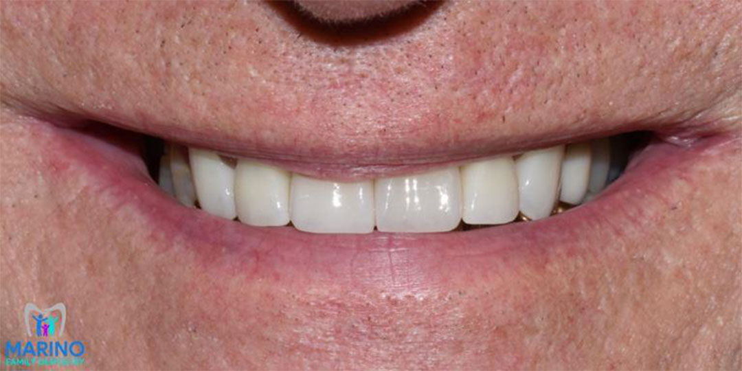 Clear Aligner Dentist Near Me