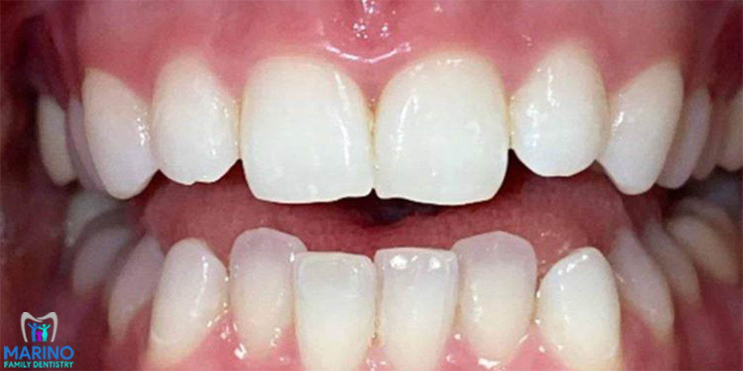 Tooth Extraction Dentist Greater Jacksonville Florida