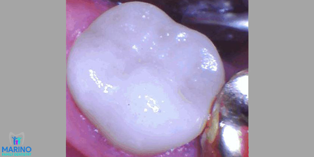 Tooth Colored Fillings Greater Jacksonville Florida Dentist