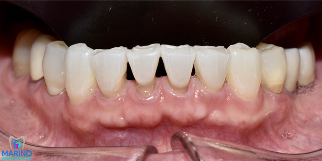 Tooth Colored Fillings Orange Park Florida